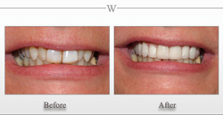 Porcelain Veneers