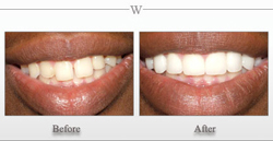 Porcelain Veneers