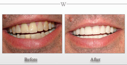 Whitening & Veneers