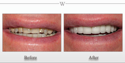 Porcelain Veneers