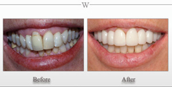 Porcelain Veneers