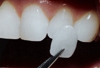 Porcelain Veneers