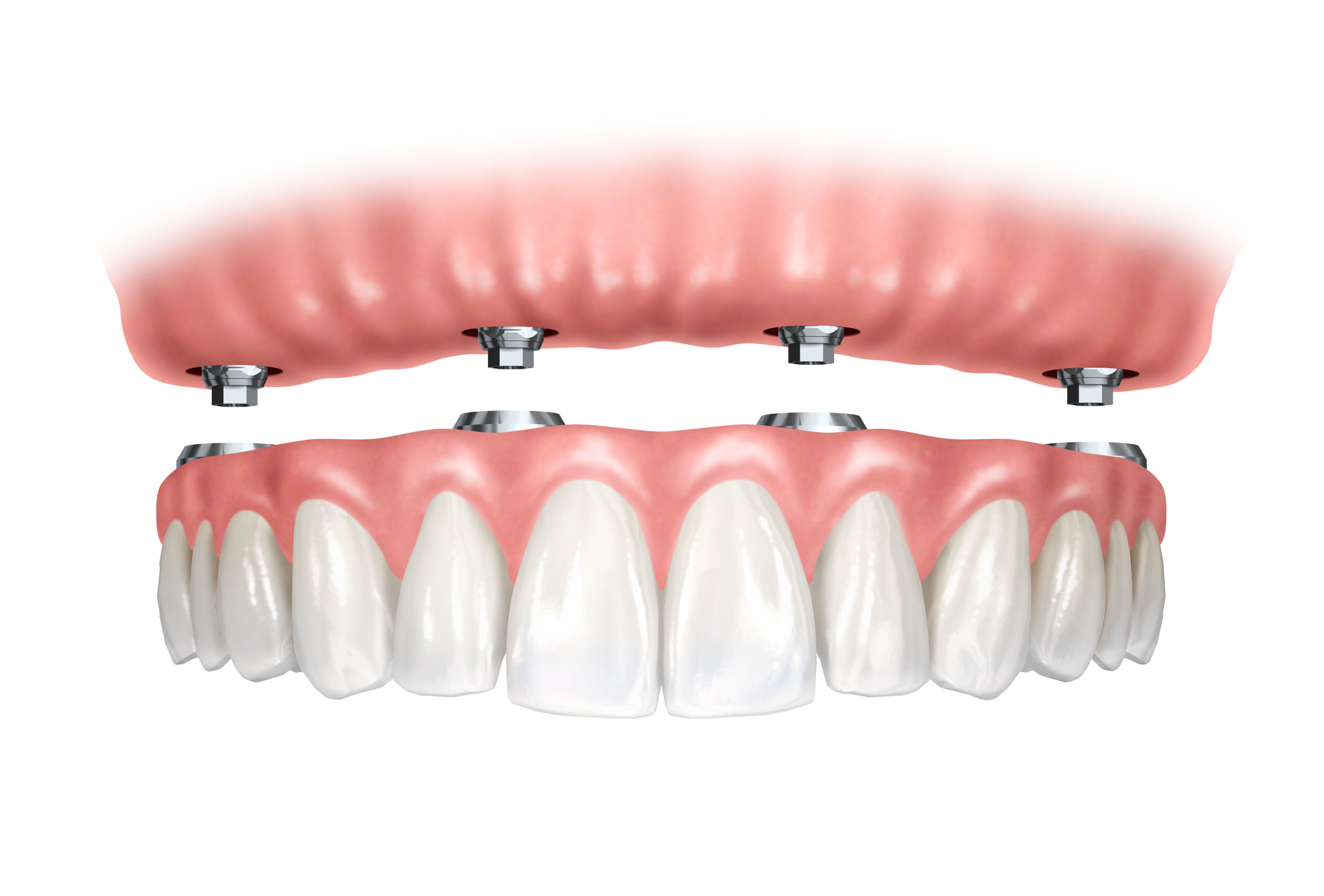 Full arch implant retained option to a traditional denture.