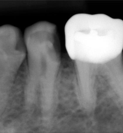 #20 Bifurcated RCT Before