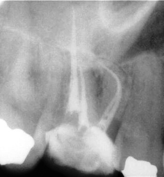#3 Extreme Curvature After