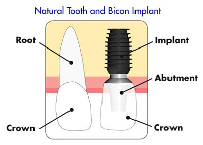 Bicon Dental Implants - Monterey CA