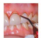 DioLase Patient