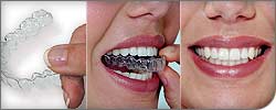 Ortho Clear Invisable Braces