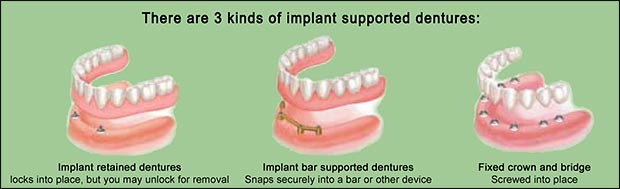 Three kinds of denture implants