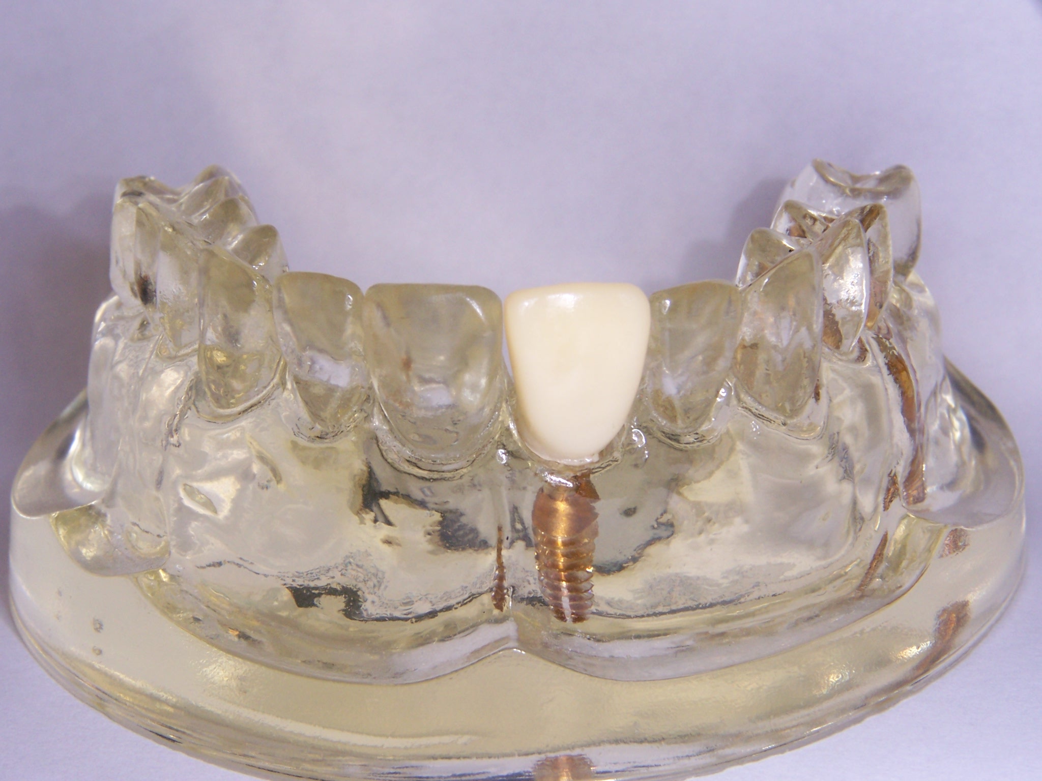 Crown / Implant