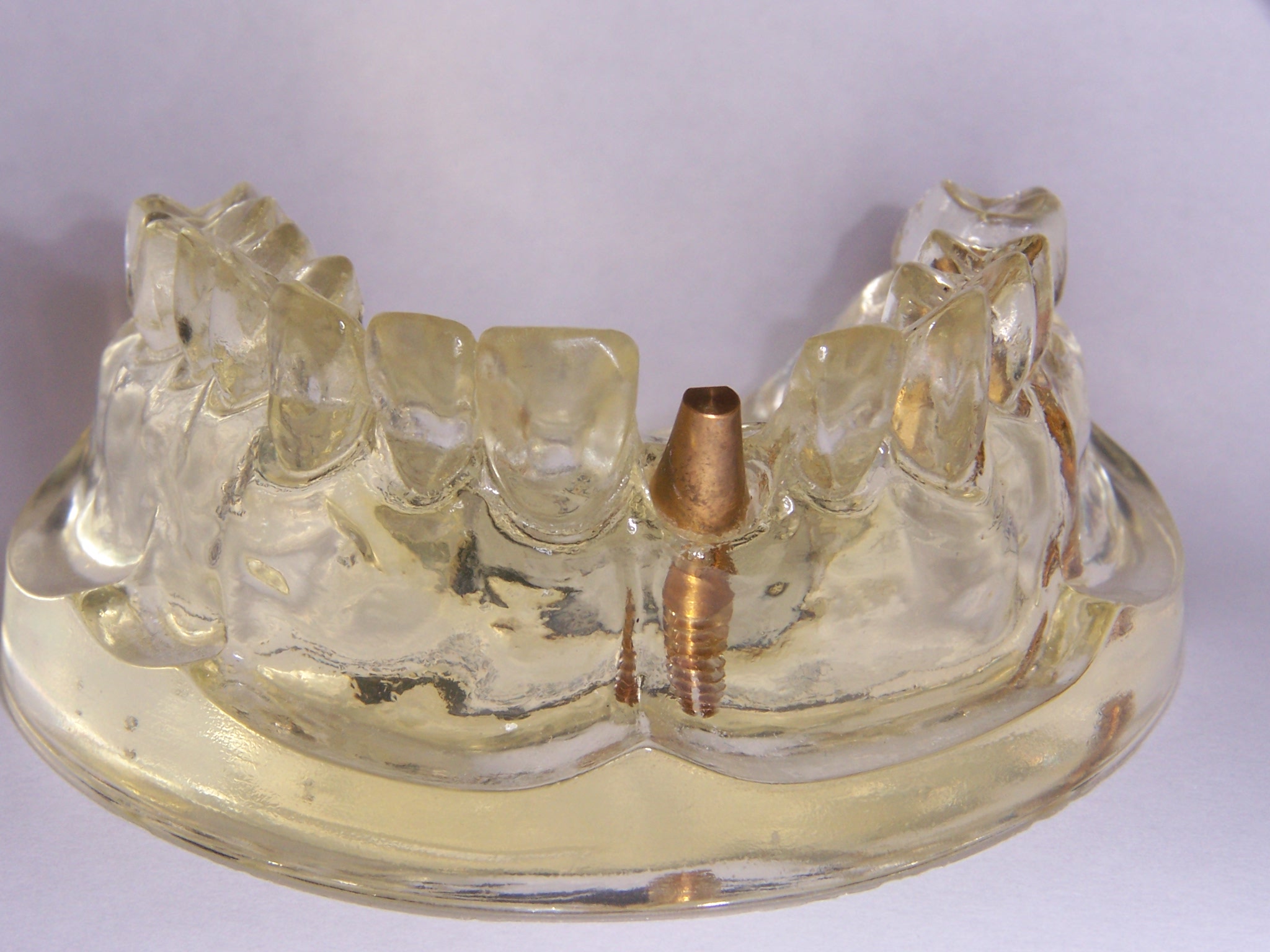 Dental implant