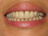 before cosmetic dentistry