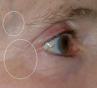 Post Treatment