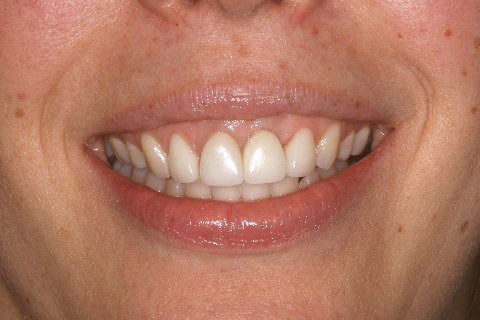 Botox Lip Treatment After