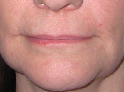 Lip Filler Before